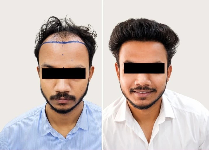 Hair Transplant Transformation 1