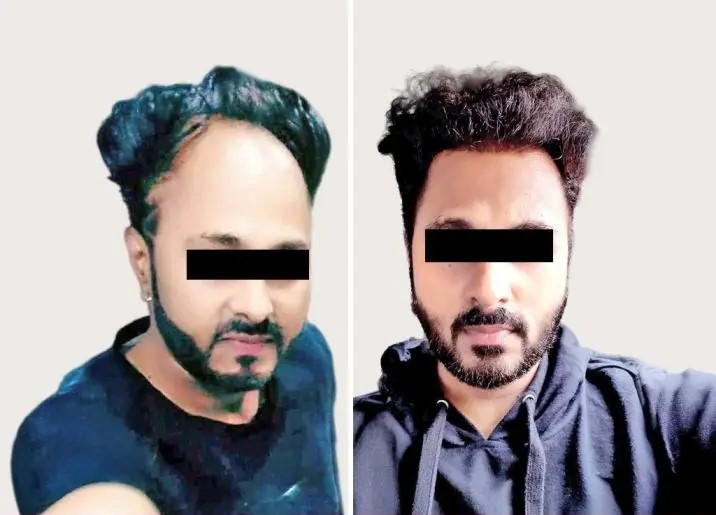 Hair Transplant Transformation 1