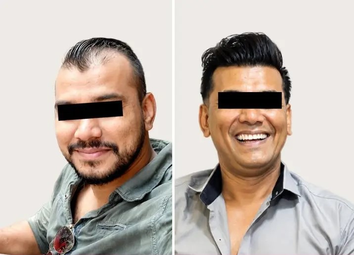 Hair Transplant Transformation 1