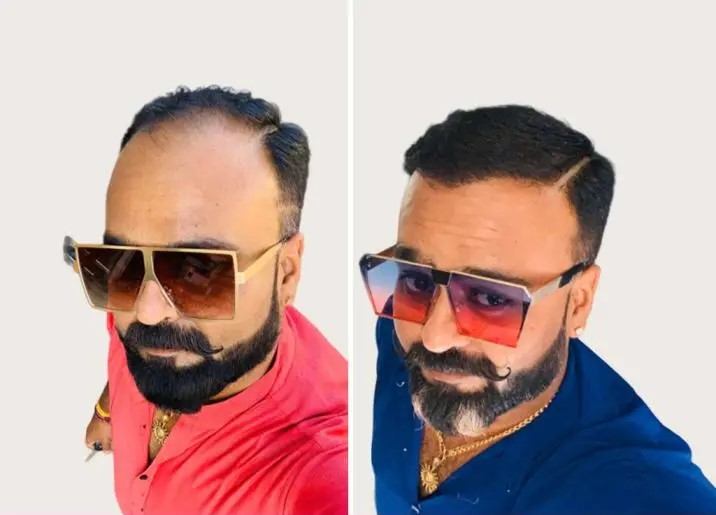 Hair Transplant Transformation 1