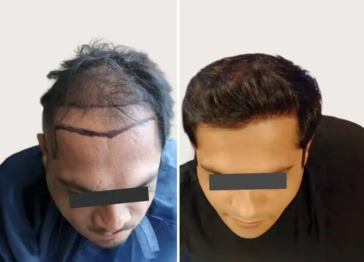 Hair Transplant Transformation 1