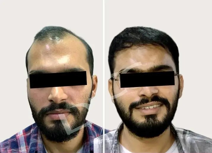 Hair Transplant Transformation 1