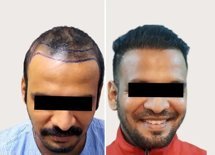 Hair Transplant Transformation 1
