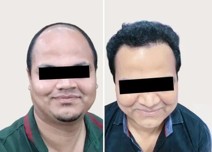 Hair Transplant Transformation 1
